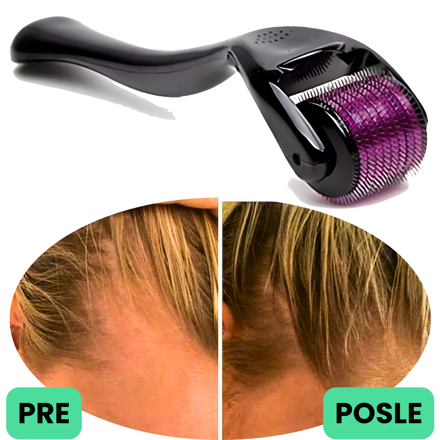 DERMA ROLER ZA RAST I JAČANJE KOSE