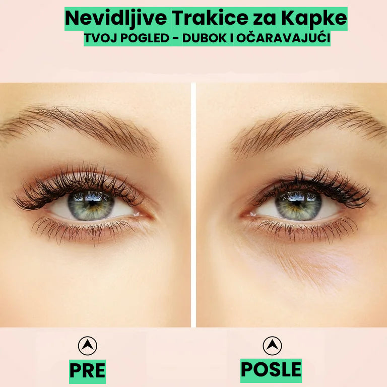 TRAKICE ZA PODIZANJE KAPAKA - 100 komada